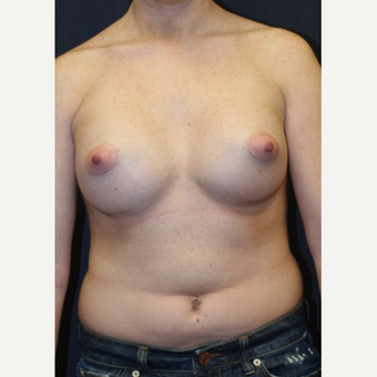 21 year old woman treated with Mentor Breast Implants after 3695675