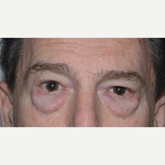 Eyelid Surgery before 3346401