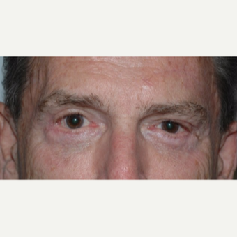 Eyelid Surgery after 3346401