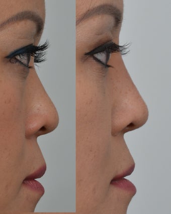 25-34 year old woman treated with Non Surgical Nose Job before 3666975