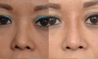 25-34 year old woman treated with Non Surgical Nose Job after 3666975