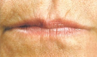 Lip enhancement before 374294