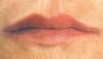 Lip enhancement after 374294