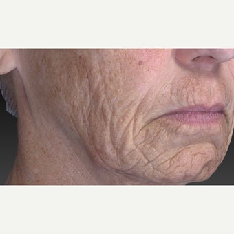 65-74 year old woman treated with CO2 Laser before 2092091