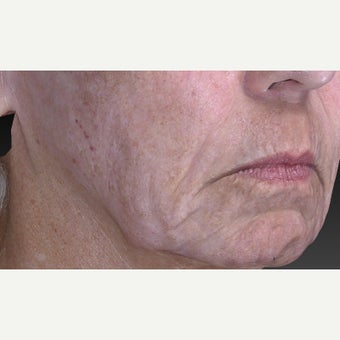 65-74 year old woman treated with CO2 Laser after 2092091