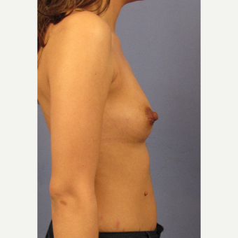 25-34 year old woman treated with Breast Augmentation before 3106222