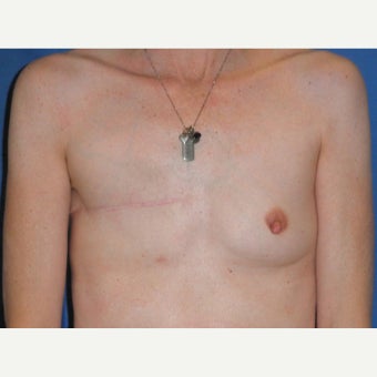 45-54 year old woman treated with Breast Reconstruction before 2417448