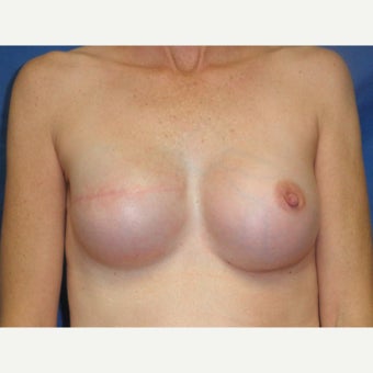 45-54 year old woman treated with Breast Reconstruction after 2417448