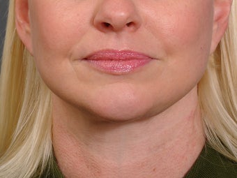 48 year old woman following neck lift as part of her facelift seen 2 years after. after 1270975