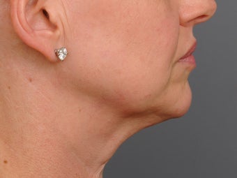 48 year old woman following neck lift as part of her facelift seen 2 years after. 1270975