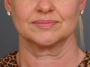 48 year old woman following neck lift as part of her facelift seen 2 years after. before 1270975