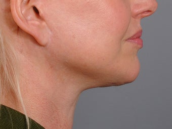 48 year old woman following neck lift as part of her facelift seen 2 years after. 1270975