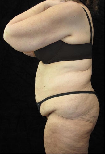 65 year old woman treated with Body Lift 3025890