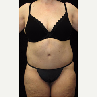 65 year old woman treated with Body Lift after 3025890