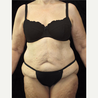 65 year old woman treated with Body Lift before 3025890