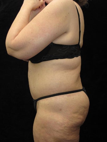 65 year old woman treated with Body Lift 3025890