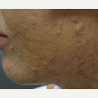 Treating acne can reduce acne scarring. before 3696970