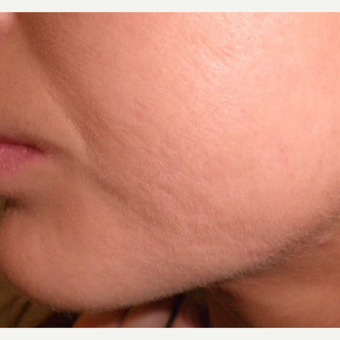 Treating acne can reduce acne scarring. after 3696970