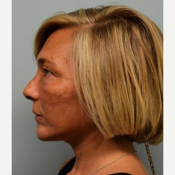 45-54 year old woman treated with Lower Face Lift after 2493176