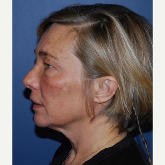 45-54 year old woman treated with Lower Face Lift before 2493176