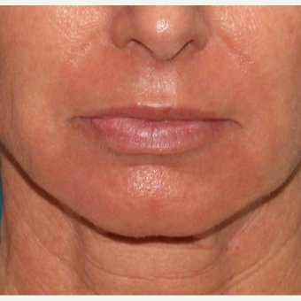 35-44 year old woman treated with Laser Resurfacing after 2706990