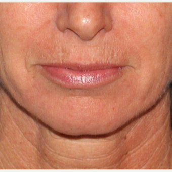 35-44 year old woman treated with Laser Resurfacing before 2706990