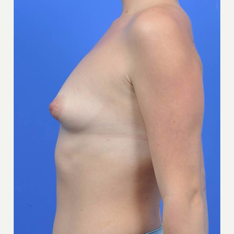 18-24 year old woman treated with Breast Augmentation before 3170863