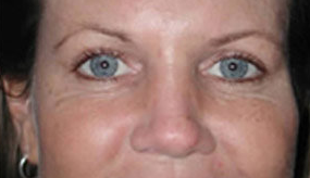 Botox for Crows Feet and Laugh Lines after 97311