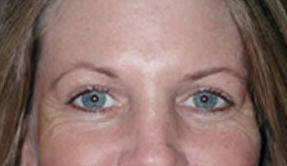 Botox for Crows Feet and Laugh Lines before 97311