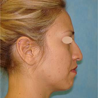 25-34 year old woman treated with Rhinoplasty before 3783352