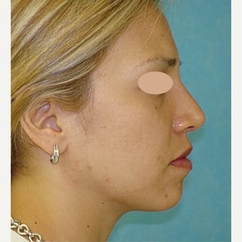 25-34 year old woman treated with Rhinoplasty after 3783352