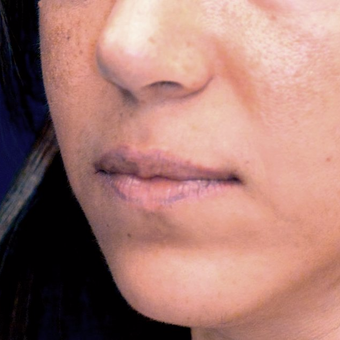 35-44 year old woman treated with Lip Lift before 3006140