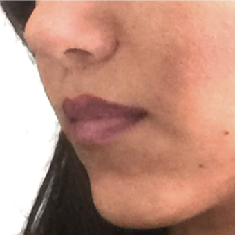35-44 year old woman treated with Lip Lift after 3006140