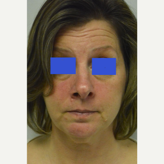 45-54 year old woman treated with Kybella before 3187165
