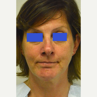 45-54 year old woman treated with Kybella after 3187165