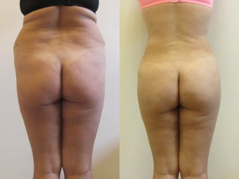 Brazilian Butt Lift before 1059227
