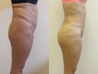 Brazilian Butt Lift after 1059227