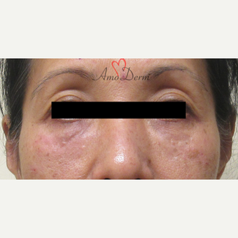 45-54 year old woman treated with Restylane after 3835983