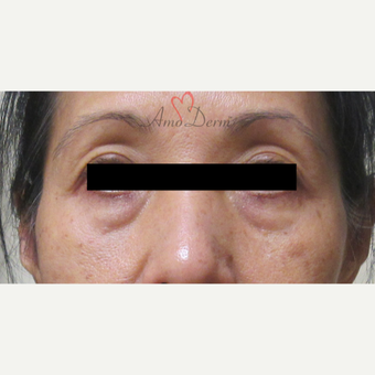 45-54 year old woman treated with Restylane before 3835983