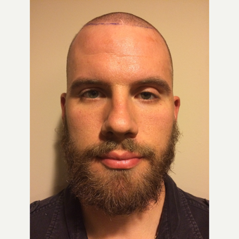 25-34 year old man treated with ARTAS Robotic Hair Transplant before 3061213