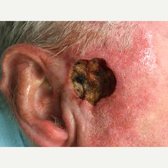 45-54 year old man treated with Mohs Surgery before 3775320