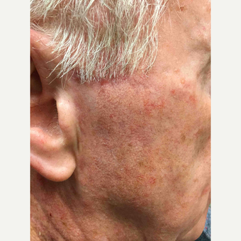 45-54 year old man treated with Mohs Surgery after 3775320