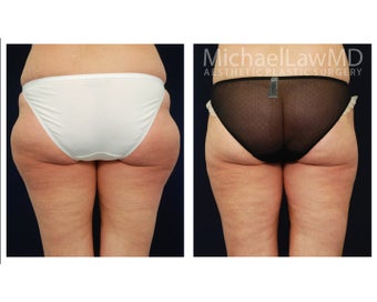 Thigh Lift before 1324036