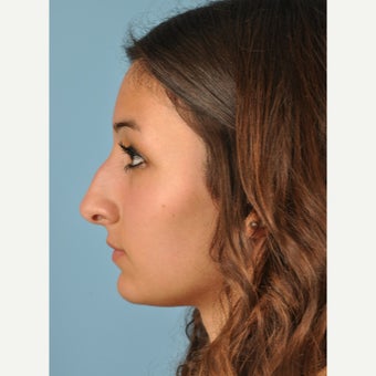 18-24 year old woman treated with Rhinoplasty before 2455990