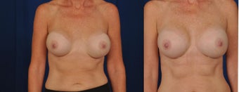 Breast Revision after 1430439