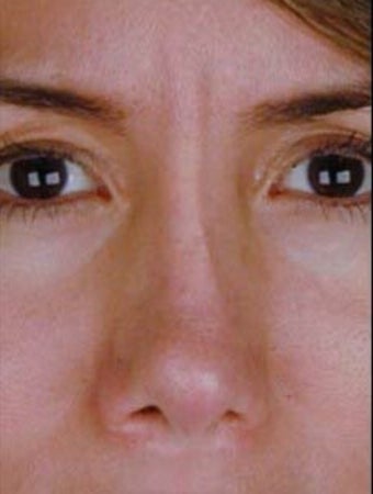 Female Revision Rhinoplasty 958923
