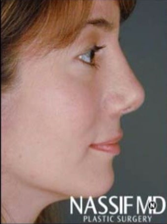 Female Revision Rhinoplasty after 958923