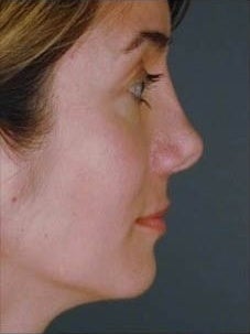 Female Revision Rhinoplasty before 958923