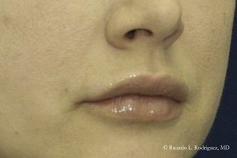 Lip Lift before 606639