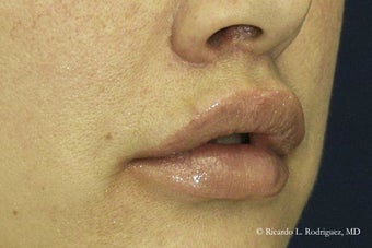 Lip Lift after 606639